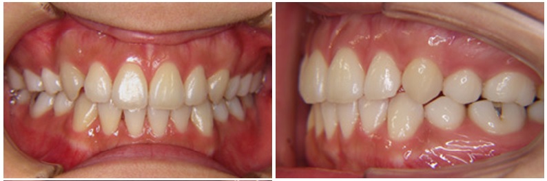 八重歯・乱ぐい歯(叢生)
