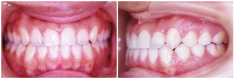 受け口(反対咬合)