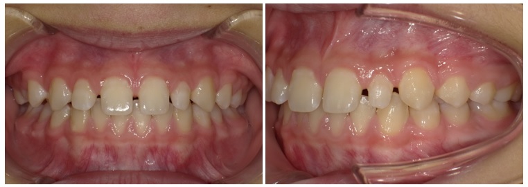 すきっ歯(空隙歯列)