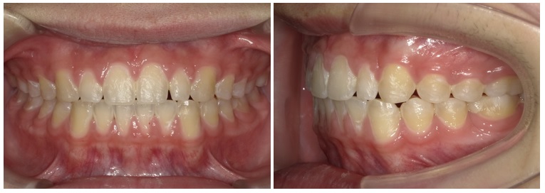 すきっ歯(空隙歯列)
