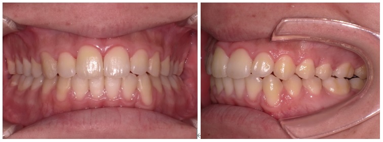 外科矯正(顎変形症)