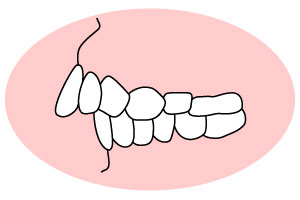 前歯が出ている「出っ歯」（上顎前突：じょうがくぜんとつ）