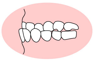 下の歯が出ている「受け口」（下顎前突：かがくぜんとつ）