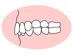 歯と歯の間にすき間がある（空隙歯列：くうげきしれつ）