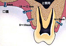 歯科矯正用アンカースクリューを用いた矯正歯科治療（Temporary Anchorage Device：TAD）とは