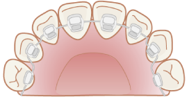 リンガルブラケット矯正（裏側矯正装置）