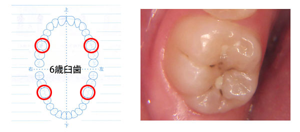 虫歯になりかかっている6歳臼歯