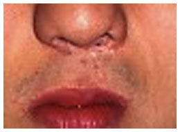 口唇裂：くちびるが割れた状態