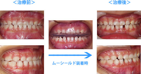 咬み合わせを改善