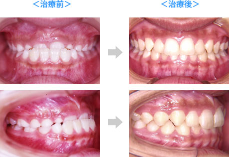 前歯1～2本の軽度の反対咬合