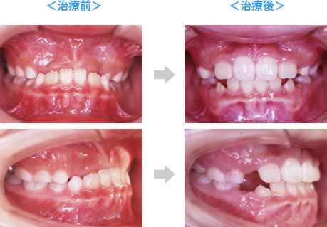 顕著な反対咬合