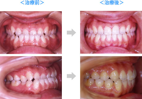 抜歯をしない場合