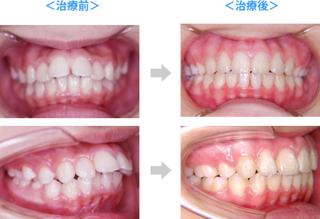 抜歯をする場合