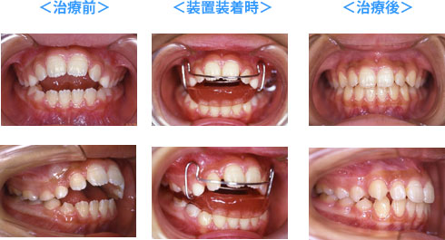 小学校 開咬